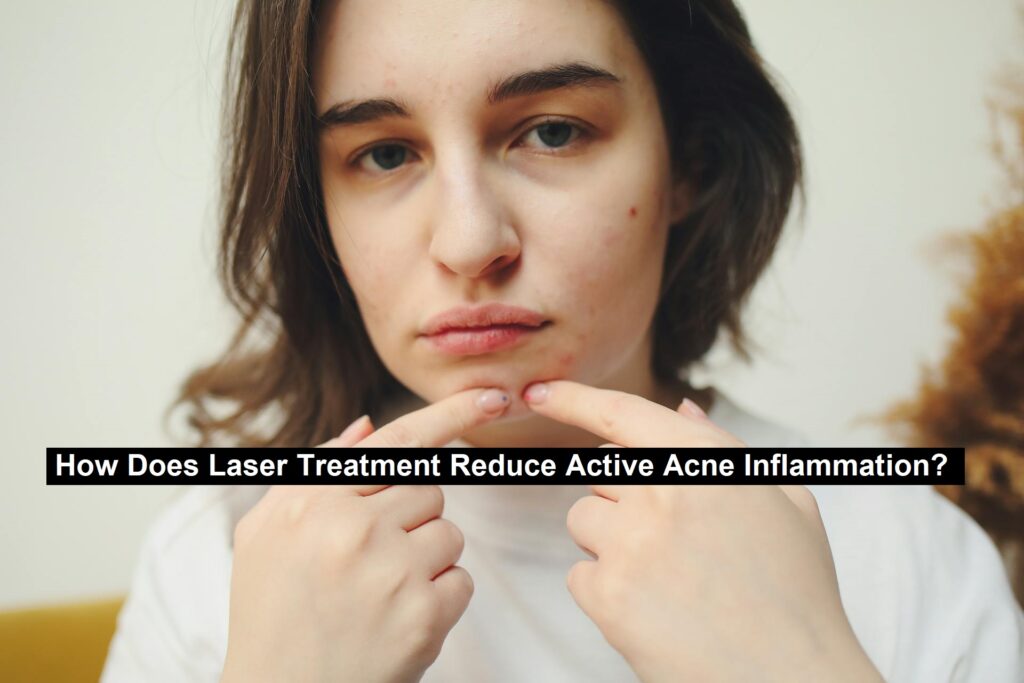 Acne Inflammation