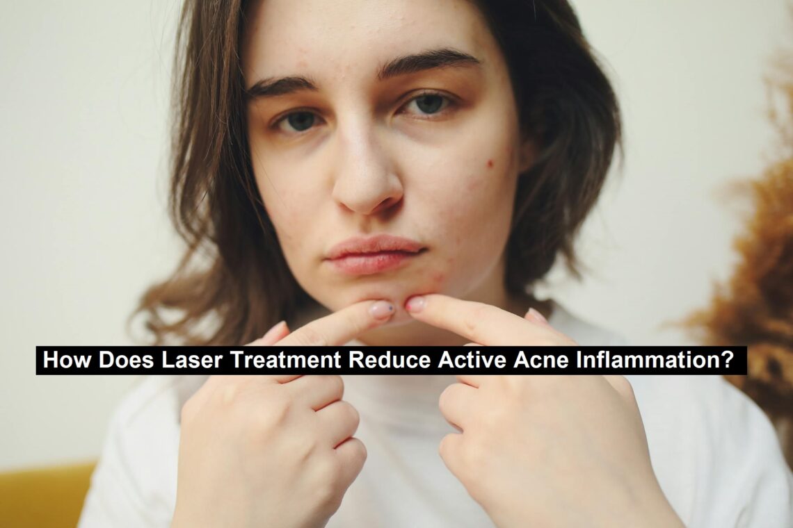 Acne Inflammation